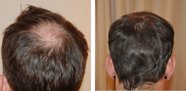 Hair Transplant