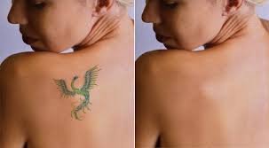 Tattoo Removal
